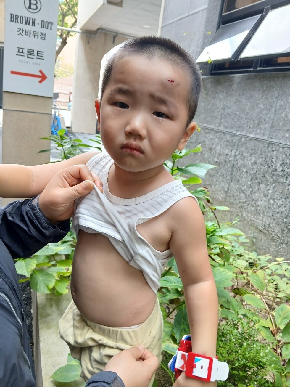 36개월 아기 계단 낙상 사고